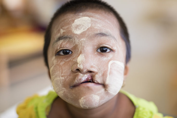 Ngwe is one of hundreds of cleft lip and palate patients who have received life changing surgery.