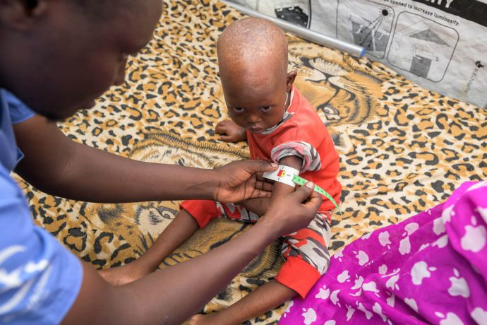 By measuring the upper arm, our trained staff can assess malnutrition and respond accordingly with doses of supplemental food. Ahmed's arm measured in the red, meaning he suffers from severe acute malnutrition. 
